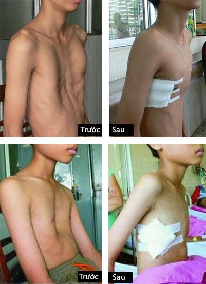Hình ảnh trước và sau khi phẫu thuật dị tật lõm ngực